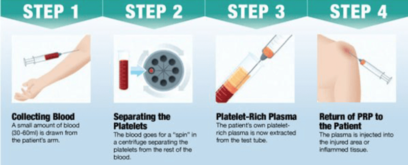 Platelet-Rich Plasma (PRP) Therapy